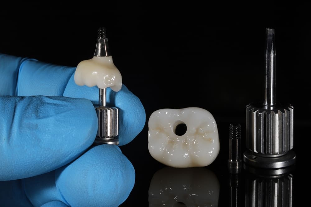 implantologia dentale Lodi